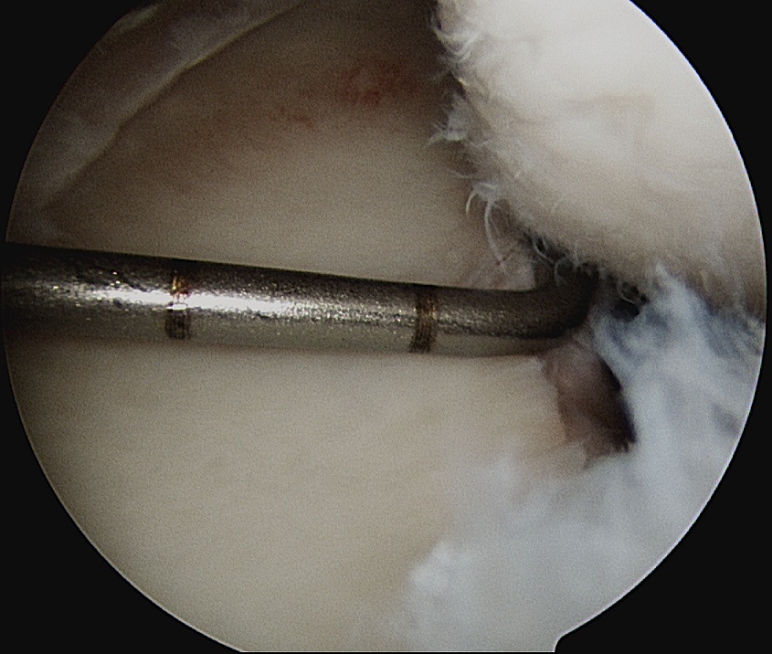 Glenoid Bone Loss Measurement 1